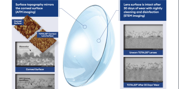 Mimicking the Corneal Surface: TOTAL30® Water Gradient Contact Lenses